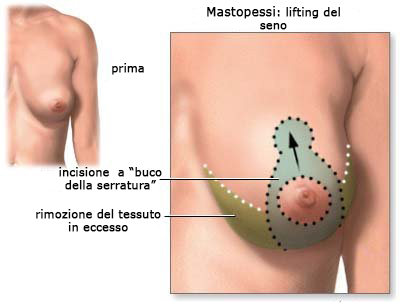 papilloma seno e allattamento