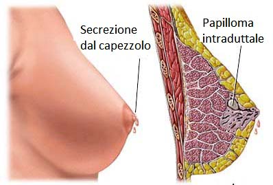 papilloma al seno sintomi